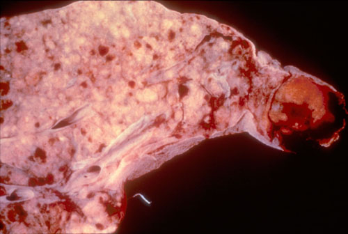 Pathology Teaching Slide Neoplasia