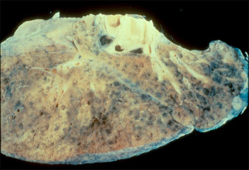 Pathology Teaching Slide - Pulmonary Pathology