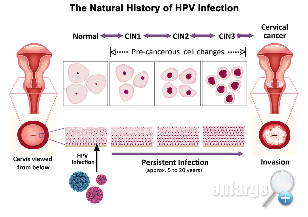 create a research question to investigate hpv