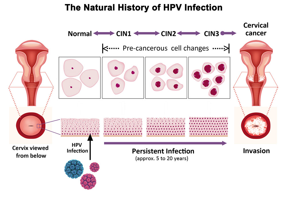 how many cervical cancer cases are caused by hpv